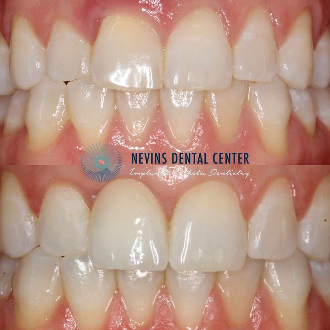 Dental Implants | Nevins Dental Center in Boston, MA This patient came to us with a periodontal infection and a root fracture, which required a dental implant