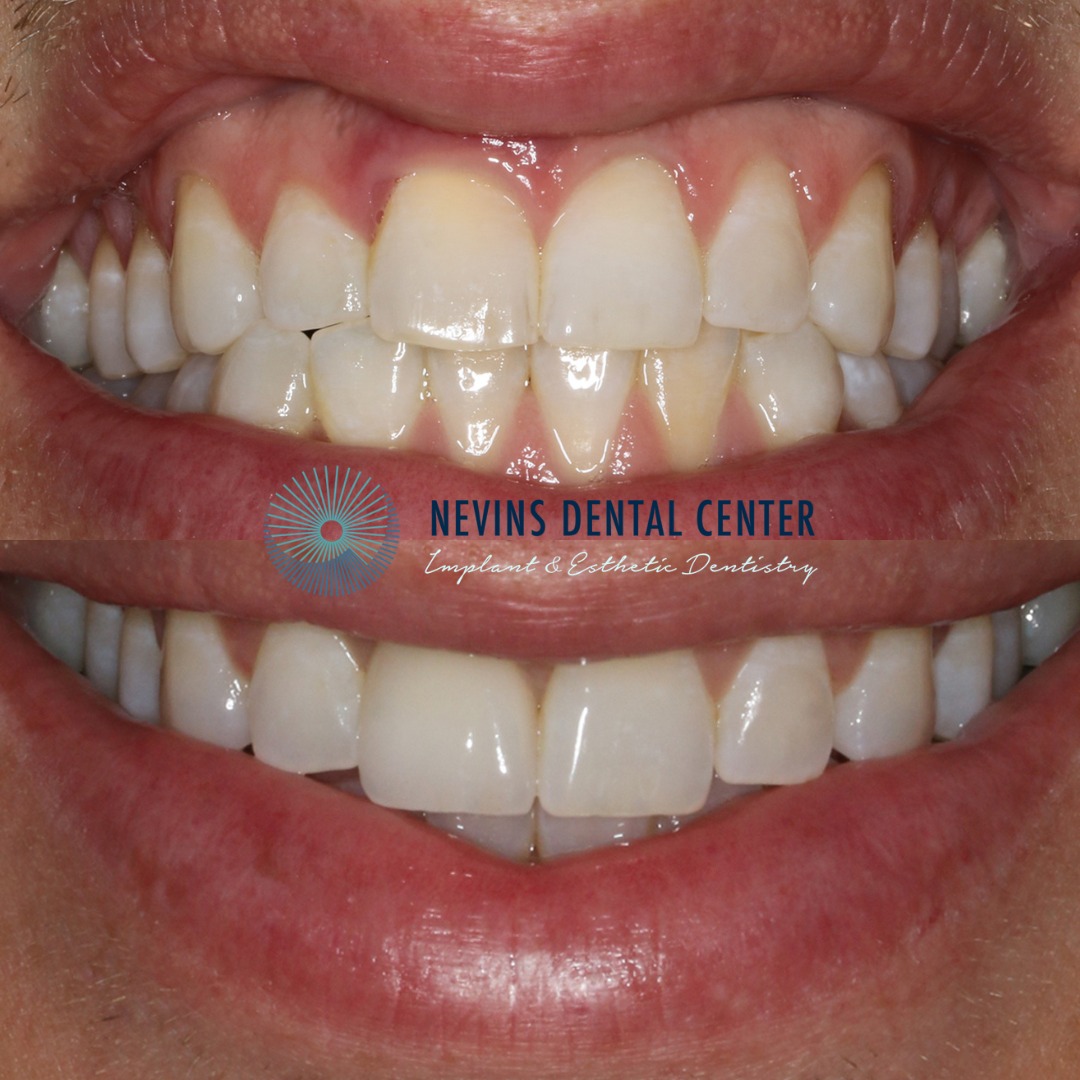 Dental Implants | Nevins Dental Center in Boston, MA This patient came to us with a periodontal infection and a root fracture, which required a dental implant