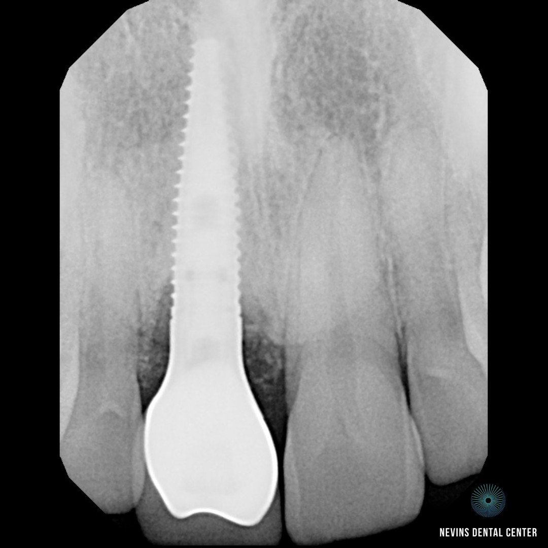 Dental Implants | Nevins Dental Center in Boston, MA This patient came to us with a periodontal infection and a root fracture, which required a dental implant