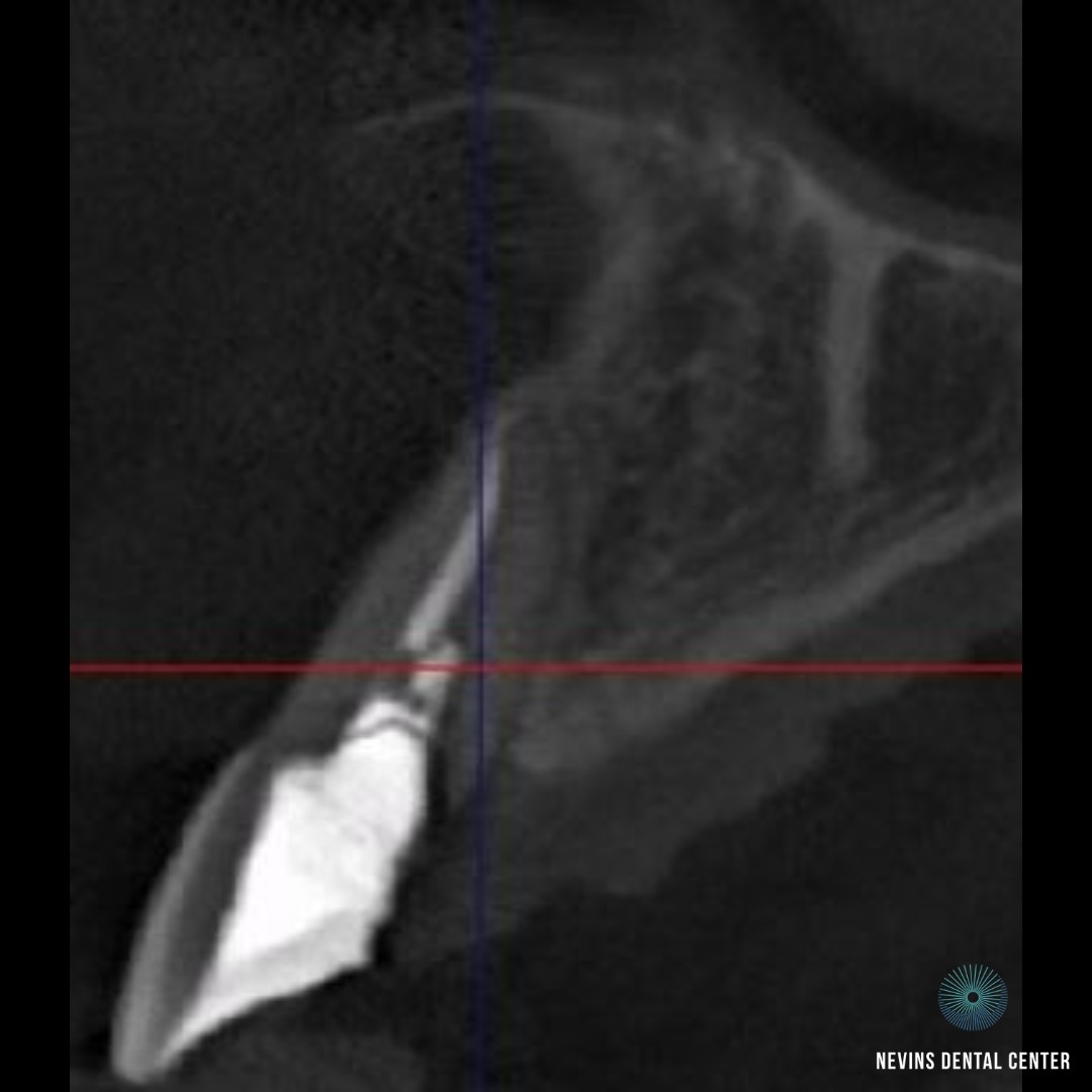 Dental Implants | Nevins Dental Center in Boston, MA This patient came to us with a periodontal infection and a root fracture, which required a dental implant