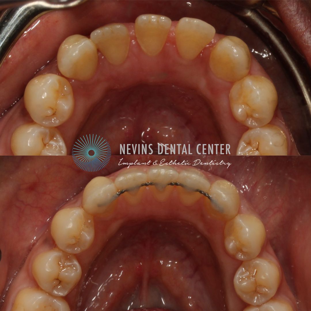 Orthodontics | Nevins Dental Center in Boston, MA Nevins Dental Center before and after dental treatment