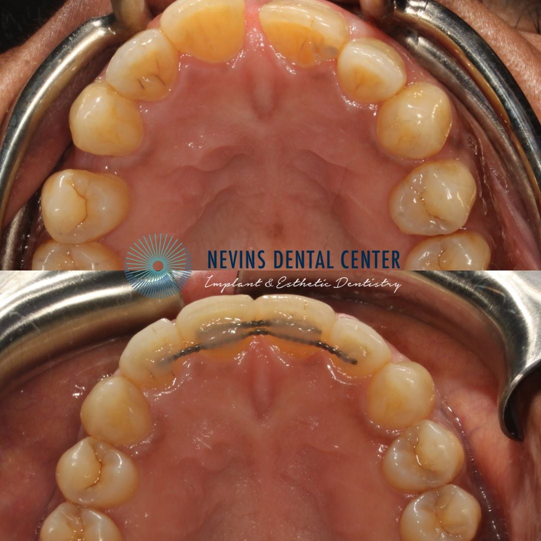 Orthodontics | Nevins Dental Center in Boston, MA Nevins Dental Center before and after dental treatment