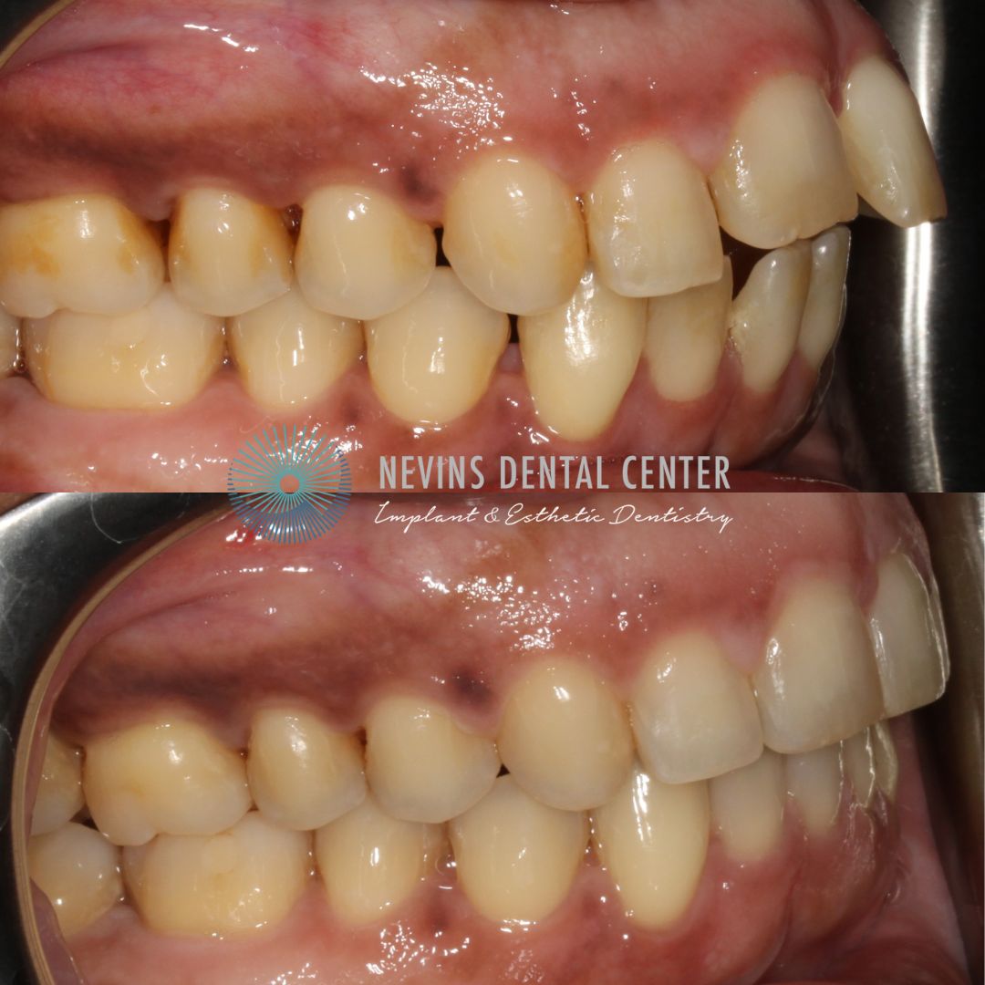 Orthodontics | Nevins Dental Center in Boston, MA Nevins Dental Center before and after dental treatment