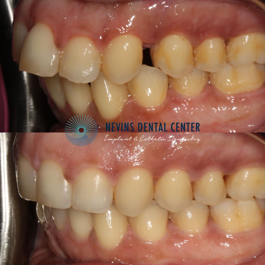 Orthodontics | Nevins Dental Center in Boston, MA Nevins Dental Center before and after dental treatment