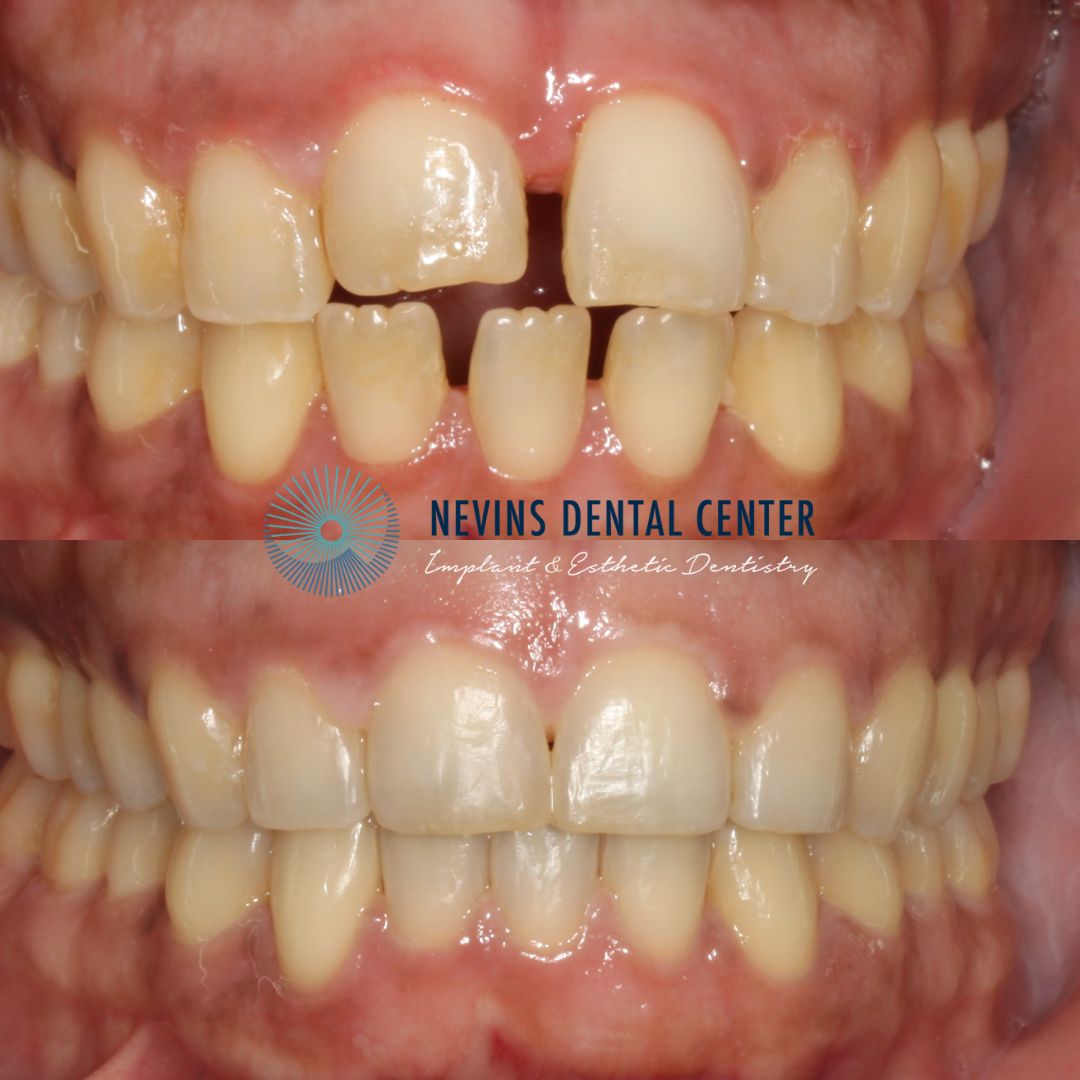 Orthodontics | Nevins Dental Center in Boston, MA Nevins Dental Center before and after dental treatment